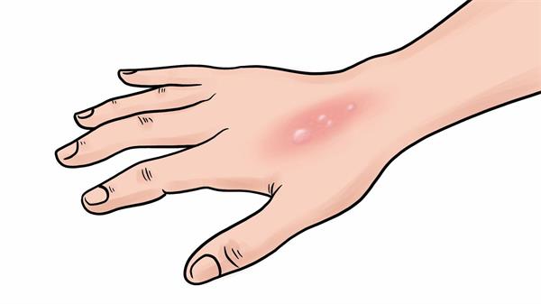 烫伤后该怎么办?科学处理避免二次伤害