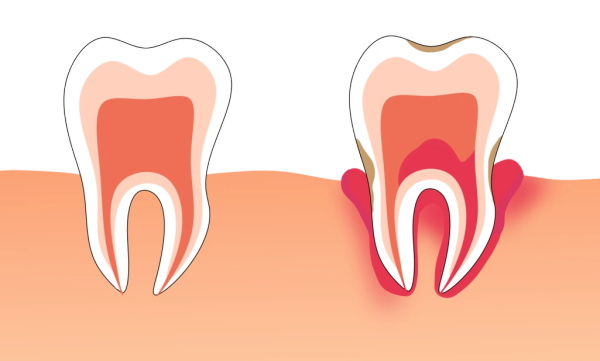 牙周炎和口臭，暗藏怎样的微生物战场？