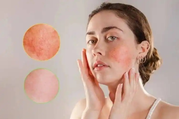 皮肤“敏感”就等于“过敏”？别被表象误导了真相