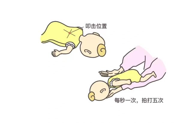 关键时刻能救命(2):异物卡喉、骨折、手指切断、煤气中毒的正确处理方式