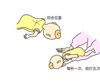 关键时刻能救命（2）：异物卡喉、骨折、手指切断、煤气中毒的正确处理方式