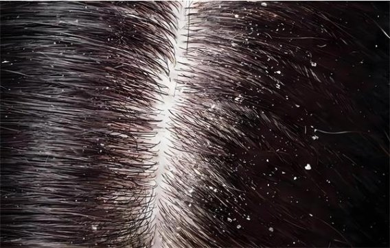洗头加点醋能去头皮屑吗?科学依据、正确做法与风险一次看懂
